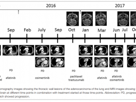 一例合并HER2扩增的奥希替尼耐药NSCLC