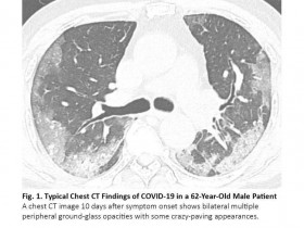 肺癌患者感染新冠肺炎COVID-19，胸部CT如何鉴别？