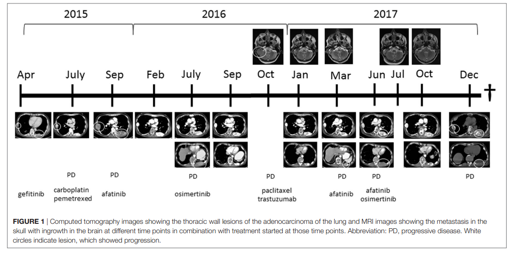 一例合并HER2扩增的奥希替尼耐药NSCLC