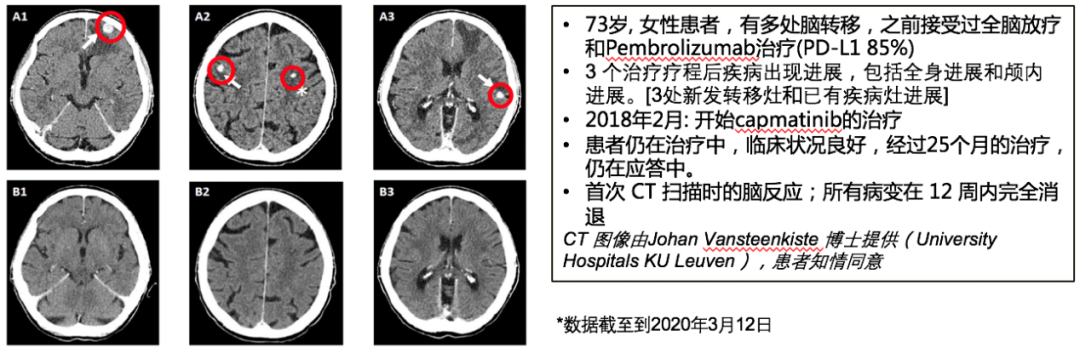 卡马替尼治疗MET14号外显子跳跃突变晚期NSCLC