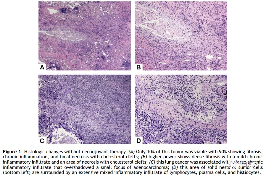肺癌新辅助治疗后如何评估病理结果？—IASLC的11大建议（上）