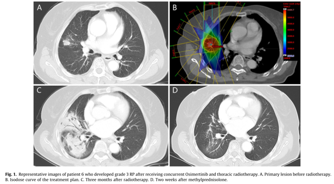 奥希替尼同步胸部放疗时高比例的放射性肺炎